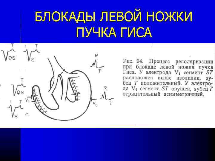 БЛОКАДЫ ЛЕВОЙ НОЖКИ ПУЧКА ГИСА 