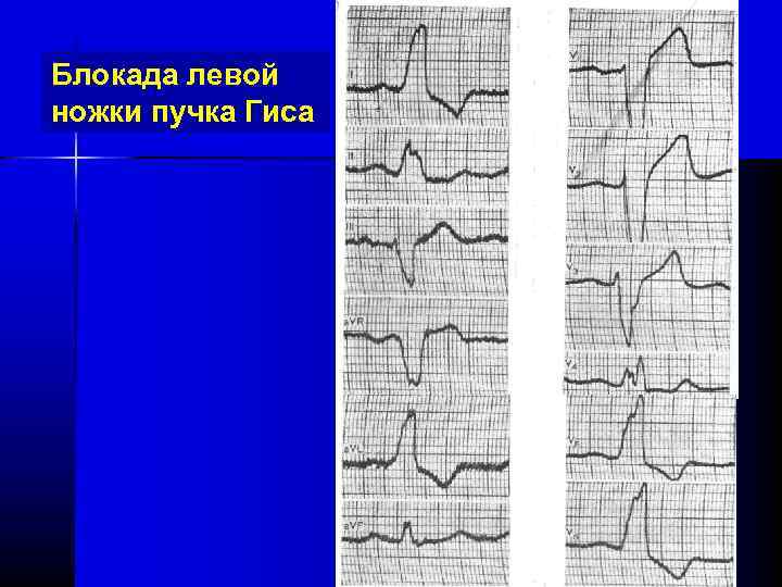 Блокада левой ножки пучка Гиса 