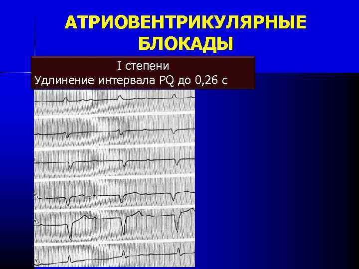 АТРИОВЕНТРИКУЛЯРНЫЕ БЛОКАДЫ I степени Удлинение интервала PQ до 0, 26 с 