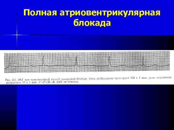 Полная атриовентрикулярная блокада 