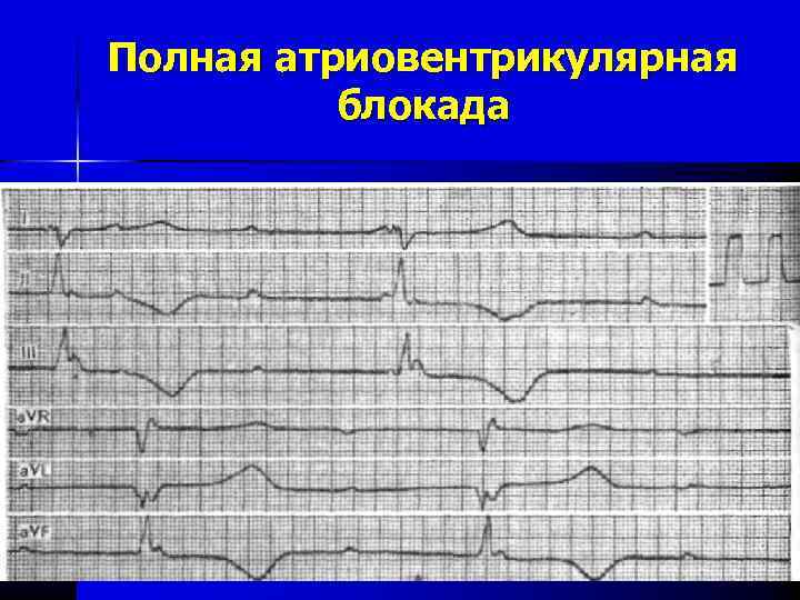 Экг нарушение проводимости