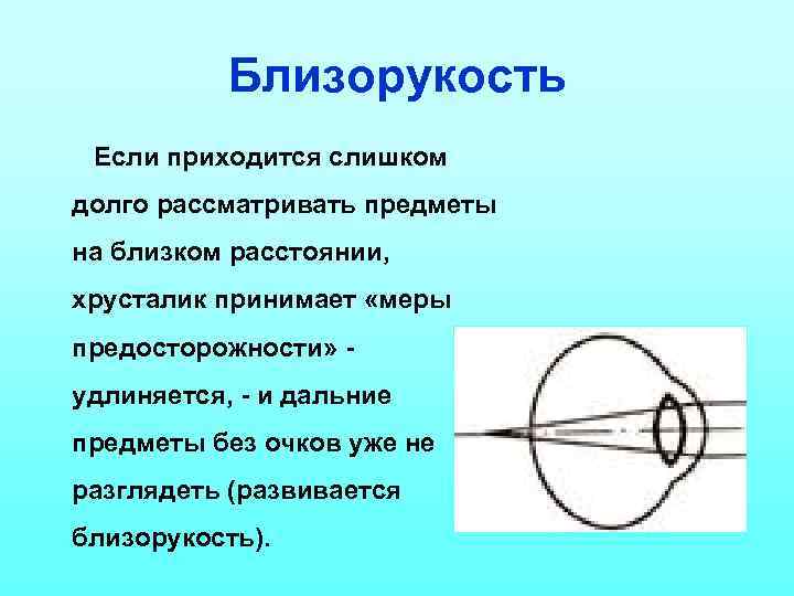 Близорукость Если приходится слишком долго рассматривать предметы на близком расстоянии, хрусталик принимает «меры предосторожности»