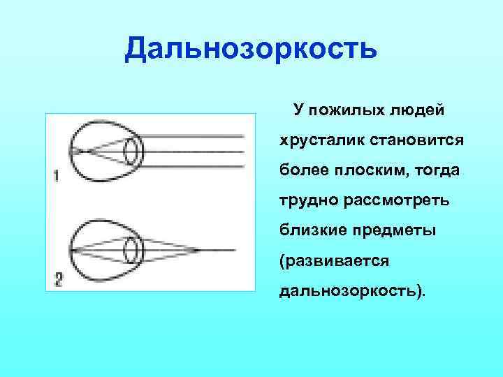 Дальнозоркость У пожилых людей хрусталик становится более плоским, тогда трудно рассмотреть близкие предметы (развивается