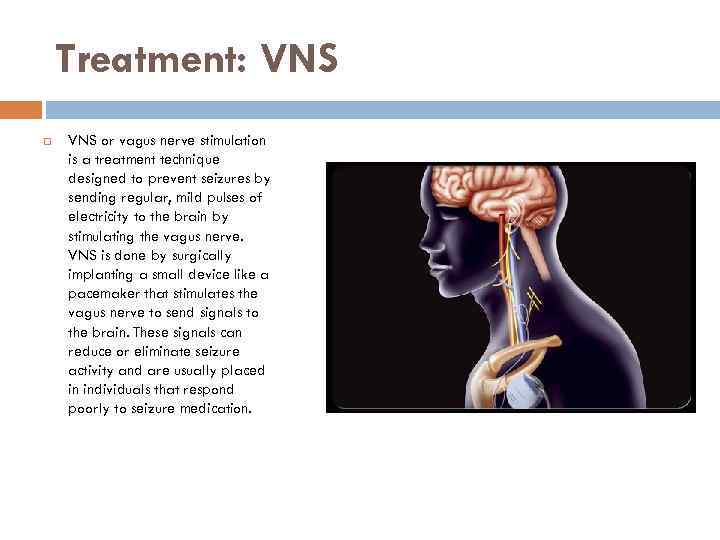 Treatment: VNS or vagus nerve stimulation is a treatment technique designed to prevent seizures