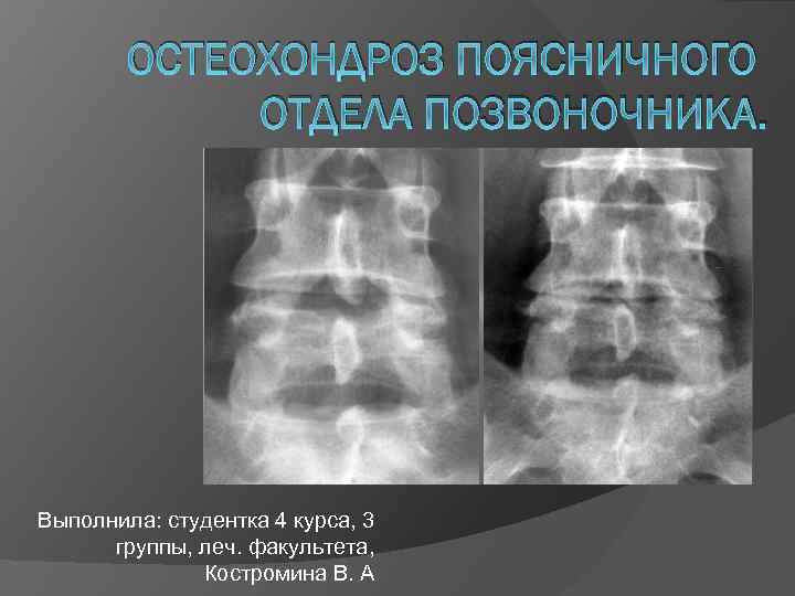 ОСТЕОХОНДРОЗ ПОЯСНИЧНОГО ОТДЕЛА ПОЗВОНОЧНИКА. Выполнила: студентка 4 курса, 3 группы, леч. факультета, Костромина В.