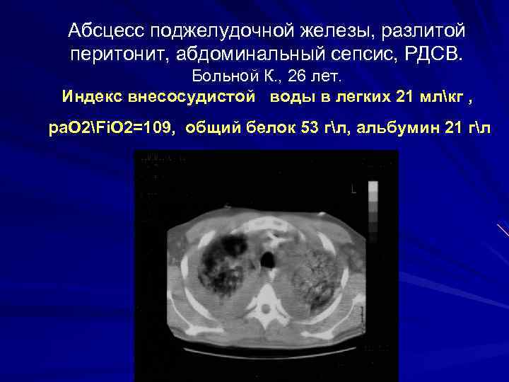 Абсцесс поджелудочной железы, разлитой перитонит, абдоминальный сепсис, РДСВ. Больной К. , 26 лет. Индекс