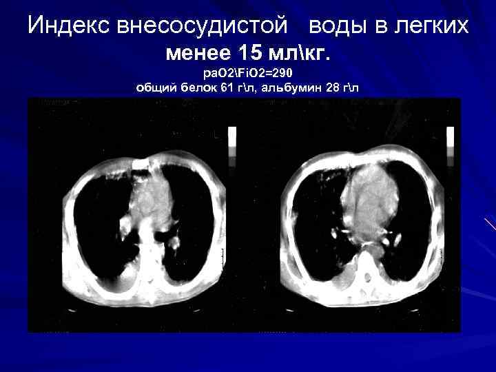 Индекс внесосудистой воды в легких менее 15 млкг. pa. O 2Fi. O 2=290 общий