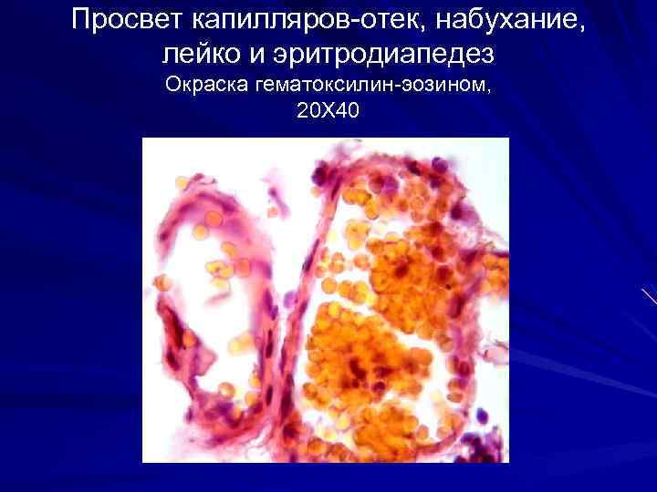 Просвет капилляров-отек, набухание, лейко и эритродиапедез Окраска гематоксилин-эозином, 20 Х 40 