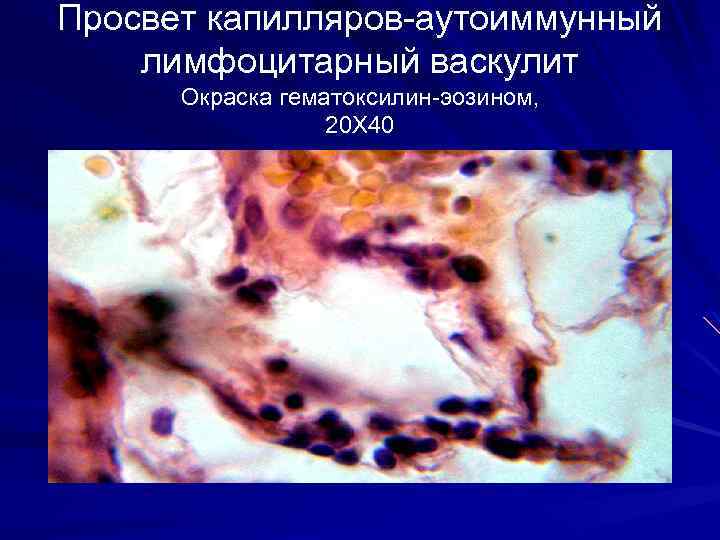 Просвет капилляров-аутоиммунный лимфоцитарный васкулит Окраска гематоксилин-эозином, 20 Х 40 