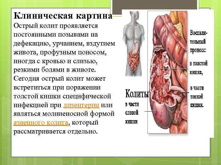 Клиническая картина Острый колит проявляется постоянными позывами на дефекацию, урчанием, вздутием живота, профузным поносом,