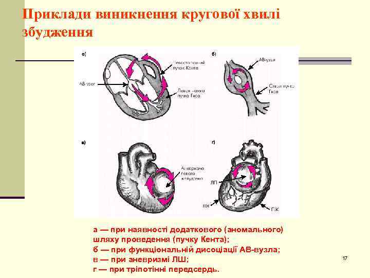 Приклади виникнення кругової хвилі збудження а — при наявності додаткового (аномального) шляху проведення (пучку