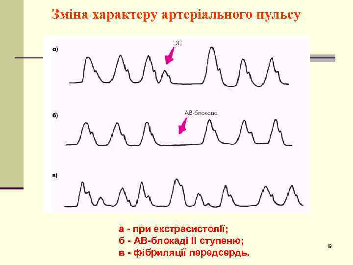Зміна характеру артеріального пульсу а - при екстрасистолії; б - АВ-блокаді II ступеню; в