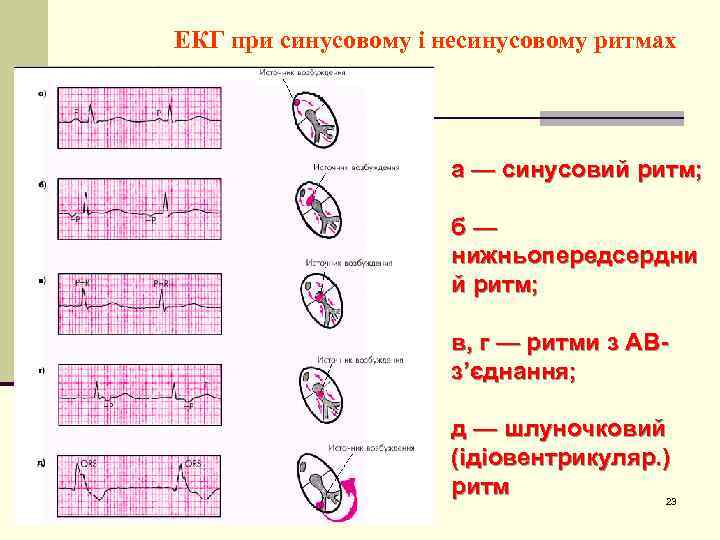 ЕКГ при синусовому і несинусовому ритмах а — синусовий ритм; б — нижньопередсердни й