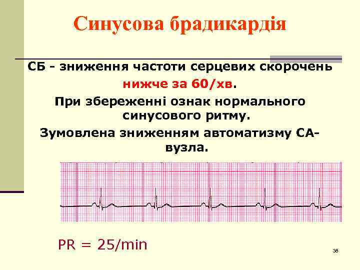 Синусова брадикардія СБ - зниження частоти серцевих скорочень нижче за 60/хв. При збереженні ознак