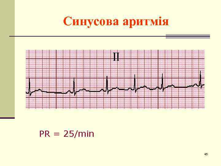 Синусова аритмія PR = 25/min 45 