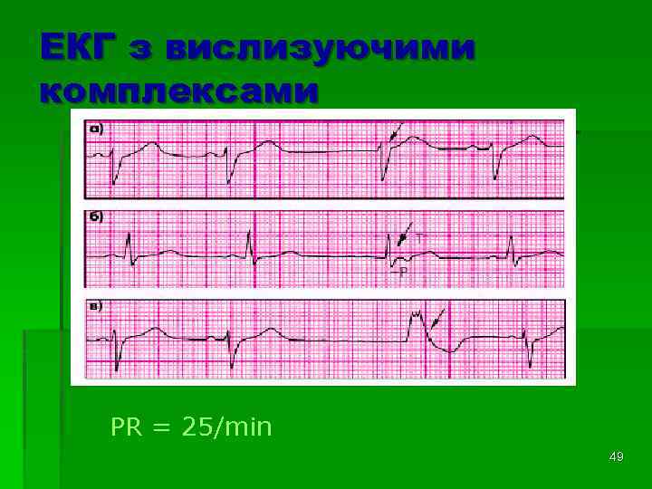 ЕКГ з вислизуючими комплексами PR = 25/min 49 