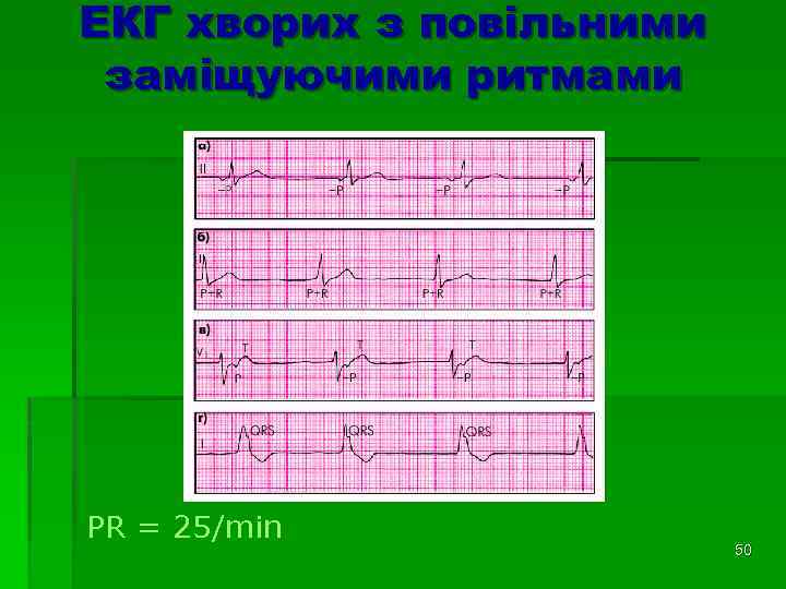 ЕКГ хворих з повільними заміщуючими ритмами PR = 25/min 50 