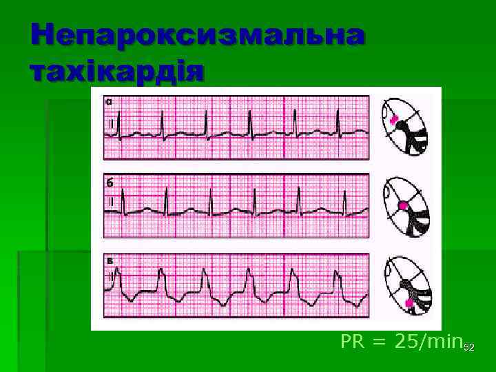 Непароксизмальна тахікардія PR = 25/min 52 