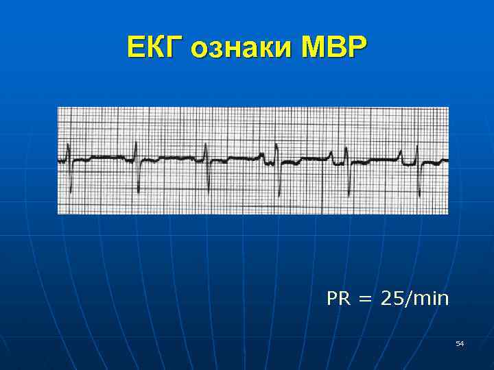 ЕКГ ознаки МВР PR = 25/min 54 