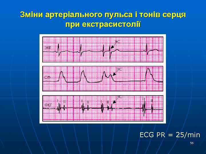 Зміни артеріального пульса і тонів серця при екстрасистолії ECG PR = 25/min 56 