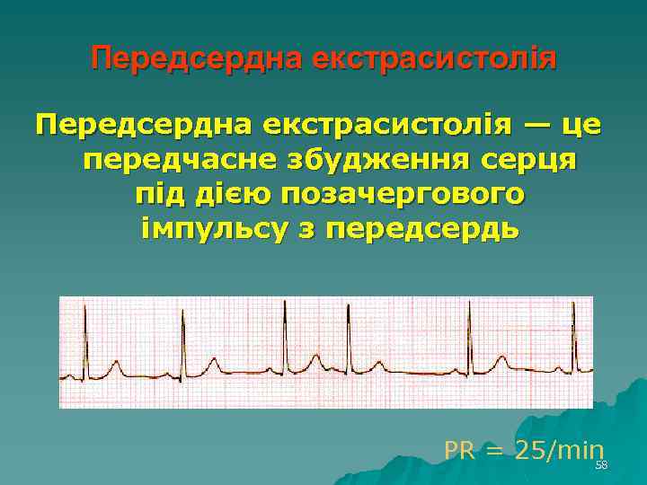 Передсердна екстрасистолія — це передчасне збудження серця під дією позачергового імпульсу з передсердь PR