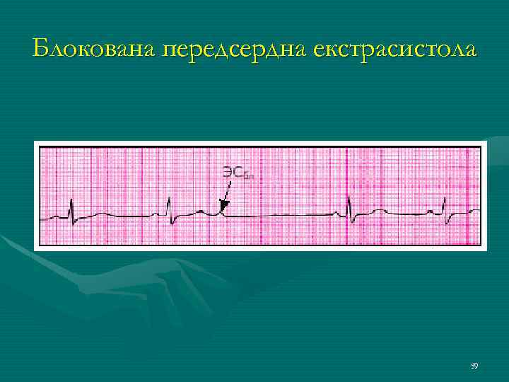 Блокована передсердна екстрасистола 59 