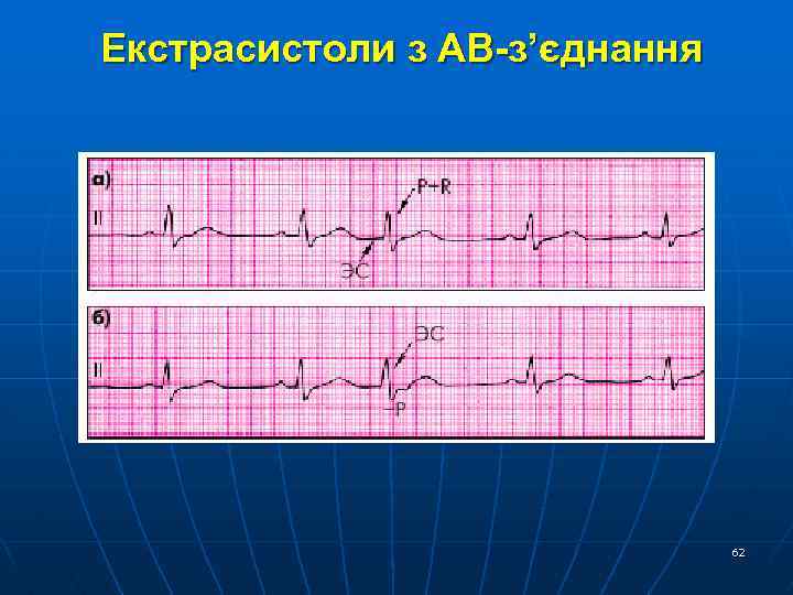  Екстрасистоли з АВ-з’єднання 62 