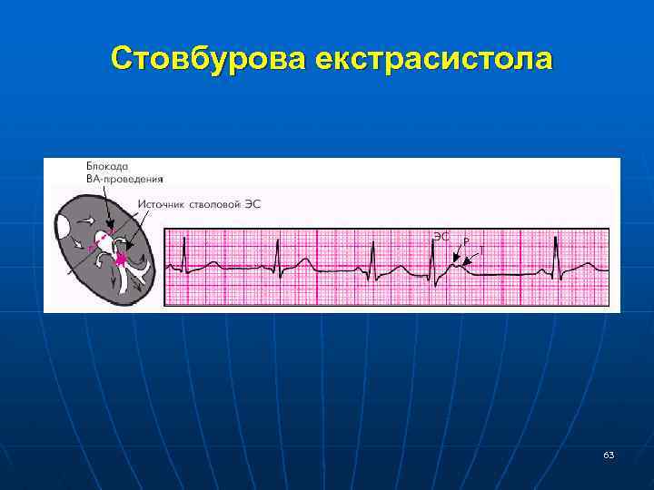  Стовбурова екстрасистола 63 