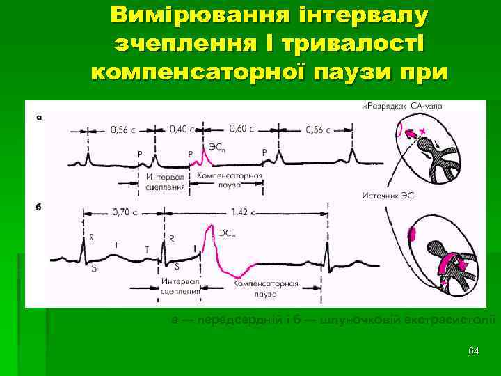 Вимірювання інтервалу зчеплення і тривалості компенсаторної паузи при а — передсердній і б —