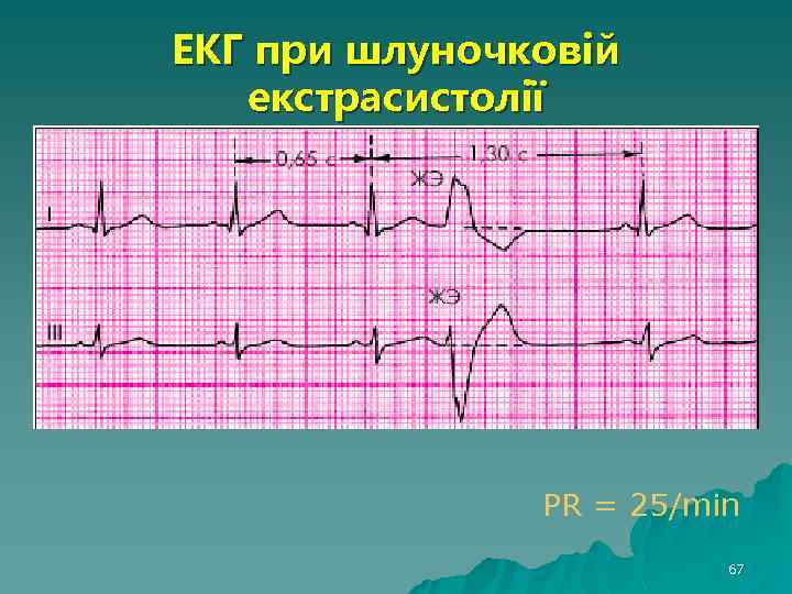 ЕКГ при шлуночковій екстрасистолії PR = 25/min 67 