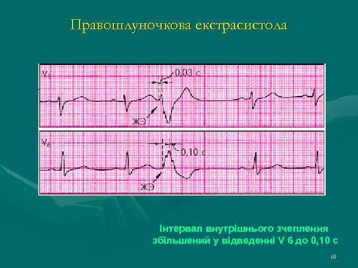 Правошлуночкова екстрасистола Інтервал внутрішнього зчеплення збільшений у відведенні V 6 до 0, 10 с