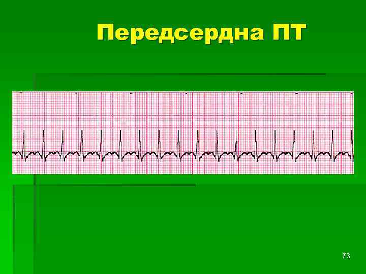 Передсердна ПТ 73 