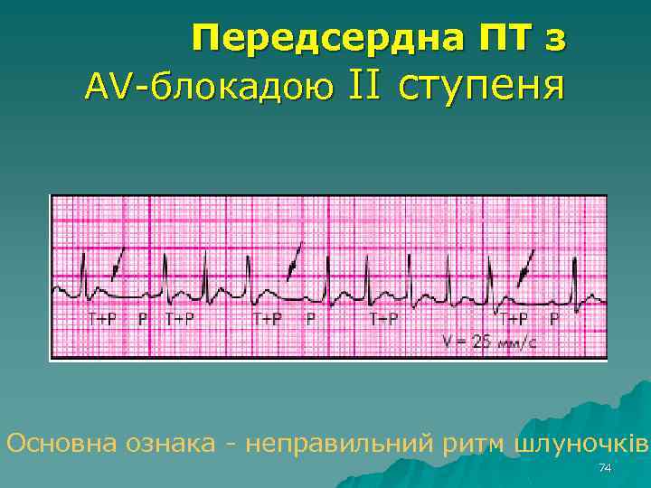 Передсердна ПТ з AV-блокадою II ступеня Основна ознака - неправильний ритм шлуночків 74 