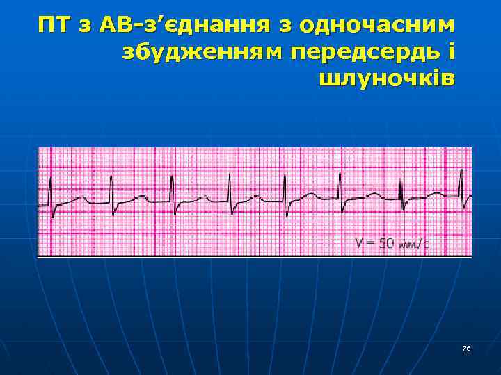 ПТ з АВ-з’єднання з одночасним збудженням передсердь і шлуночків 76 
