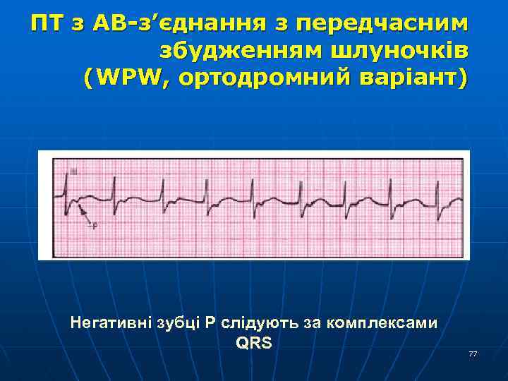 ПТ з АВ-з’єднання з передчасним збудженням шлуночків (WPW, ортодромний варіант) Негативні зубці Р слідують