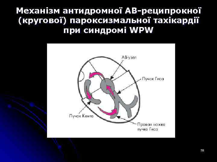 Механізм антидромної АВ-реципрокної (кругової) пароксизмальної тахікардії при синдромі WPW 78 