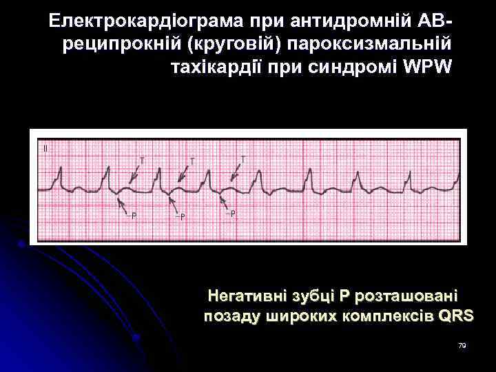 Електрокардіограма при антидромній АВреципрокній (круговій) пароксизмальній тахікардії при синдромі WPW Негативні зубці P розташовані