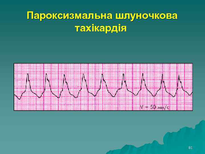  Пароксизмальна шлуночкова тахікардія 81 