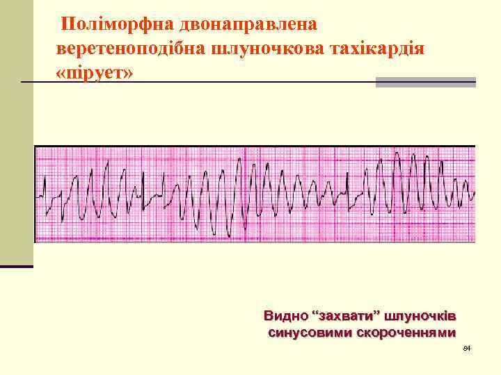 Поліморфна двонаправлена веретеноподібна шлуночкова тахікардія «пірует» Видно “захвати” шлуночків синусовими скороченнями 84 