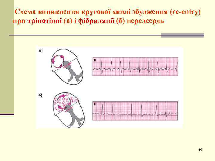 Схема виникнення кругової хвилі збудження (re-entry) при тріпотінні (а) і фібриляції (б) передсердь 86