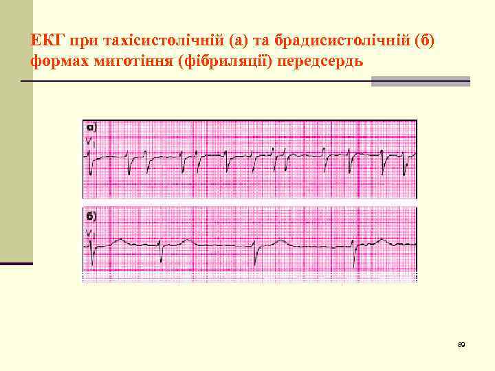 ЕКГ при тахісистолічній (а) та брадисистолічній (б) формах миготіння (фібриляції) передсердь 89 