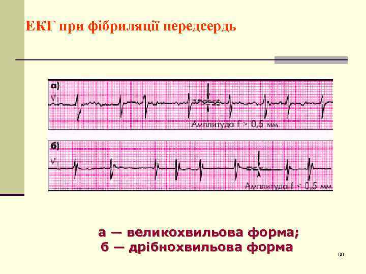 ЕКГ при фібриляції передсердь а — великохвильова форма; б — дрібнохвильова форма 90 