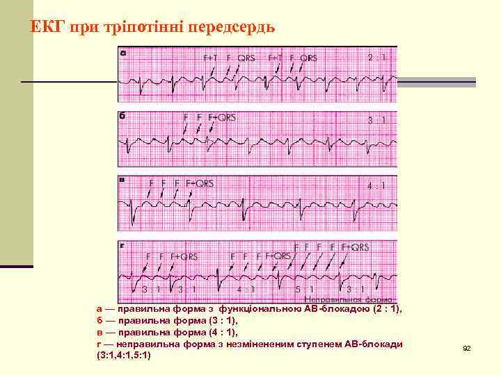 ЕКГ при тріпотінні передсердь а — правильна форма з функціональною АВ-блокадою (2 : 1),