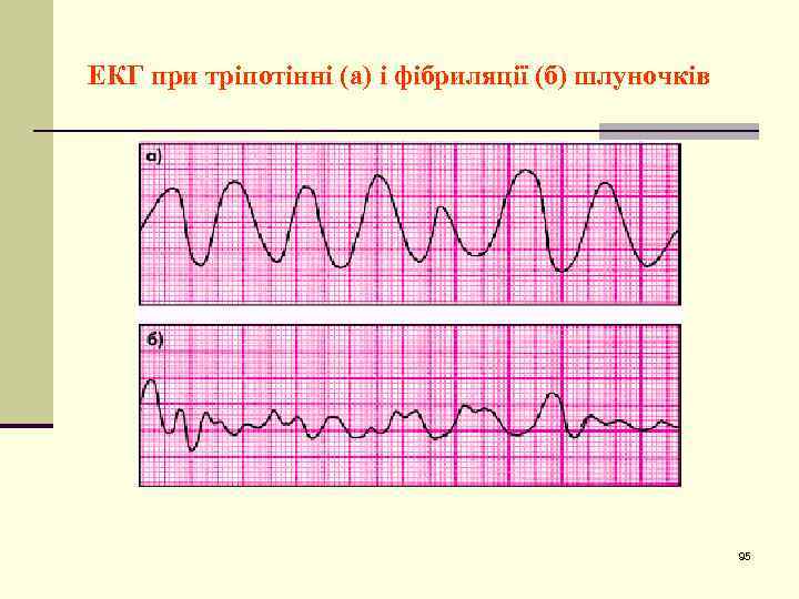 ЕКГ при тріпотінні (а) і фібриляції (б) шлуночків 95 