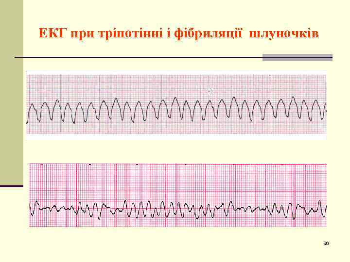 ЕКГ при тріпотінні і фібриляції шлуночків 96 