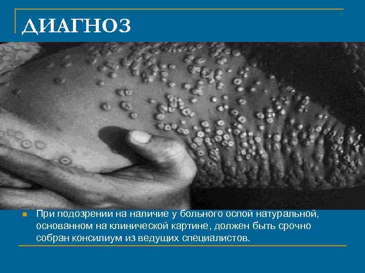 ДИАГНОЗ n При подозрении на наличие у больного оспой натуральной, основанном на клинической картине,