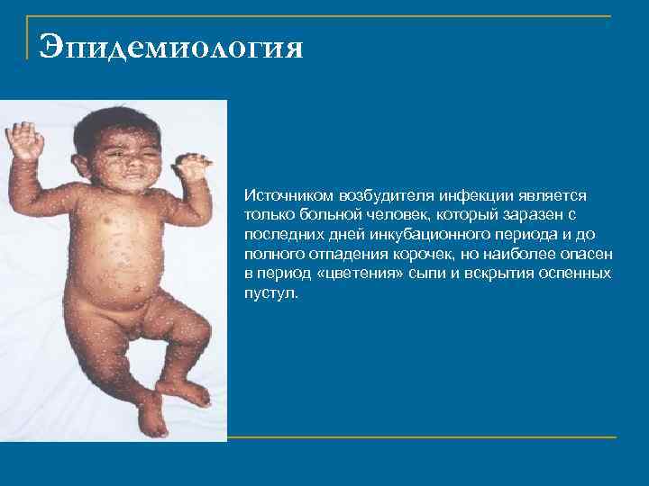 Эпидемиология Источником возбудителя инфекции является только больной человек, который заразен с последних дней инкубационного