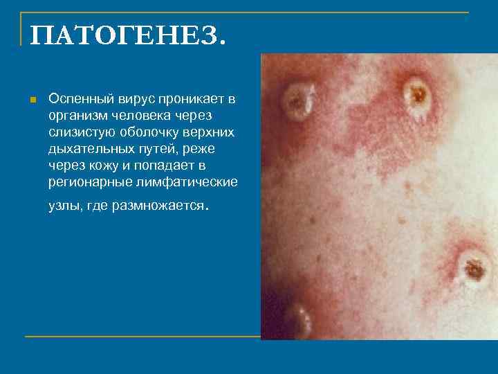 ПАТОГЕНЕЗ. n Оспенный вирус проникает в организм человека через слизистую оболочку верхних дыхательных путей,