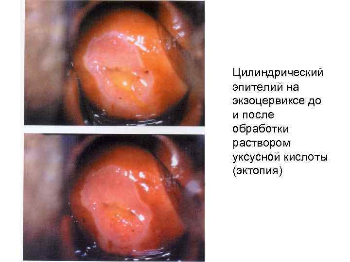 Цилиндрический эпителий на экзоцервиксе до и после обработки раствором уксусной кислоты (эктопия) 