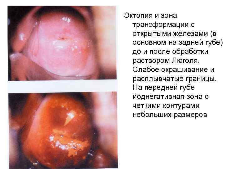 Эктопия и зона трансформации с открытыми железами (в основном на задней губе) до и